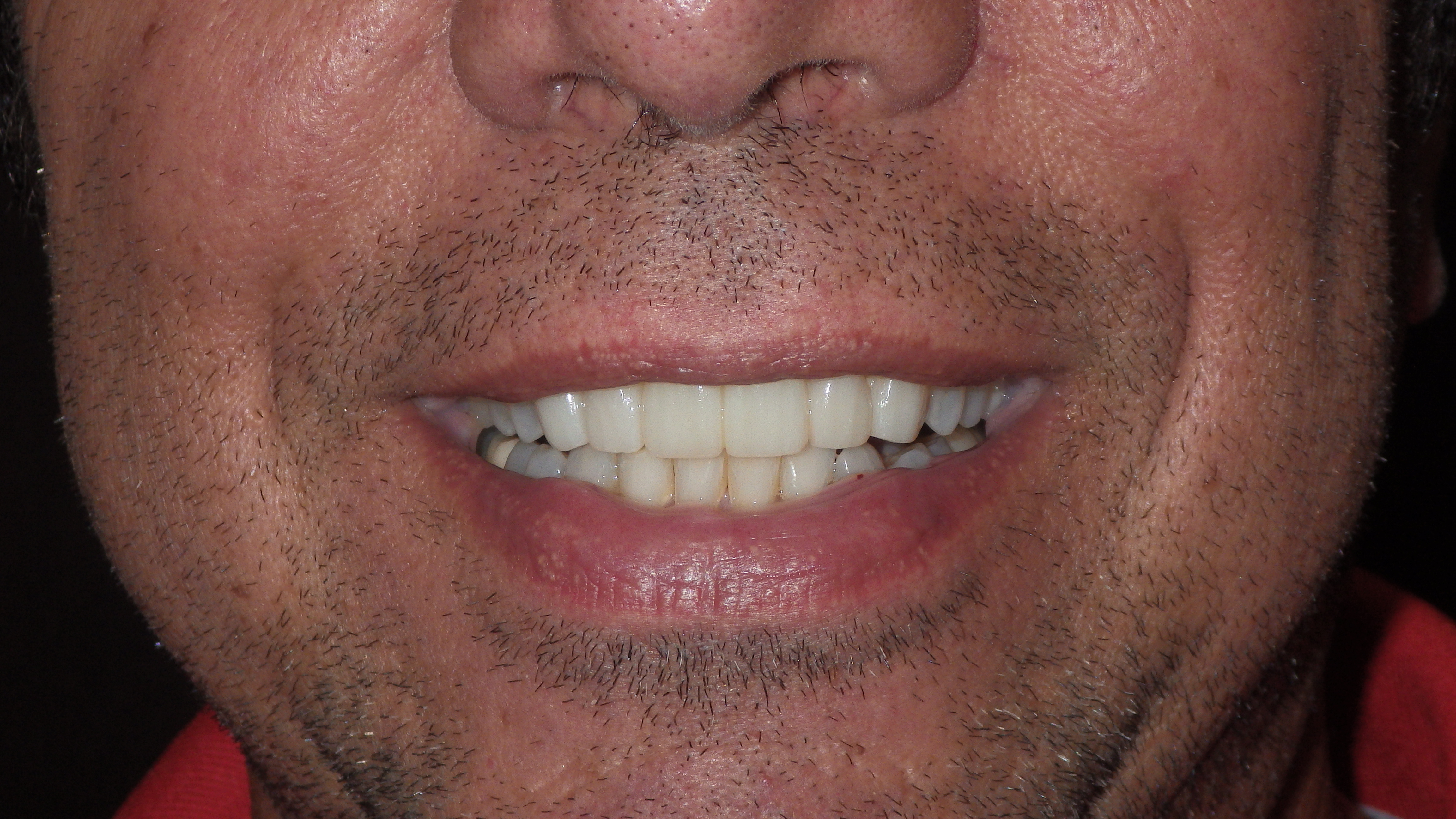 Anterior Bridge & KOR Whitening After