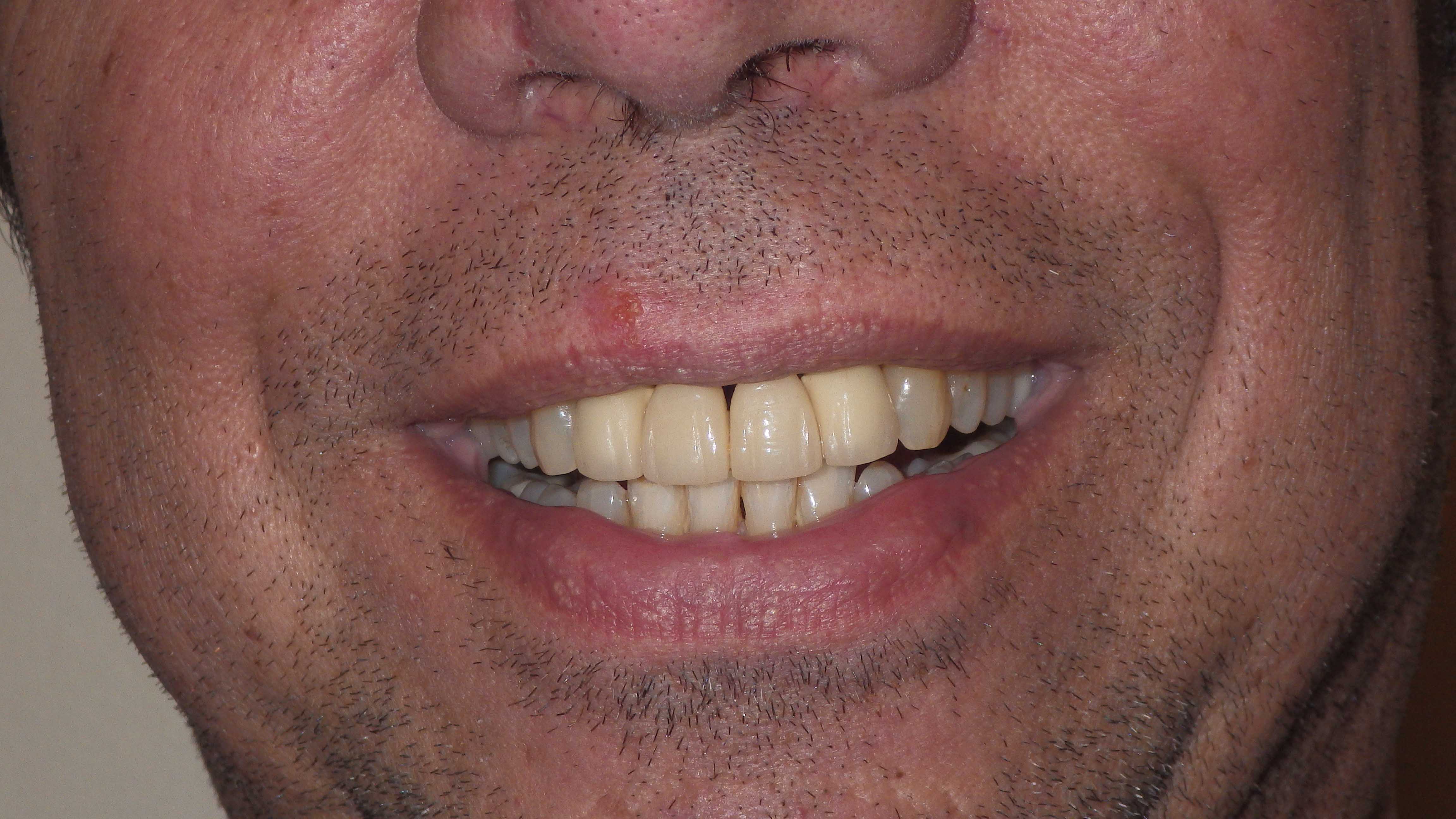 Anterior Bridge & KOR Whitening Before