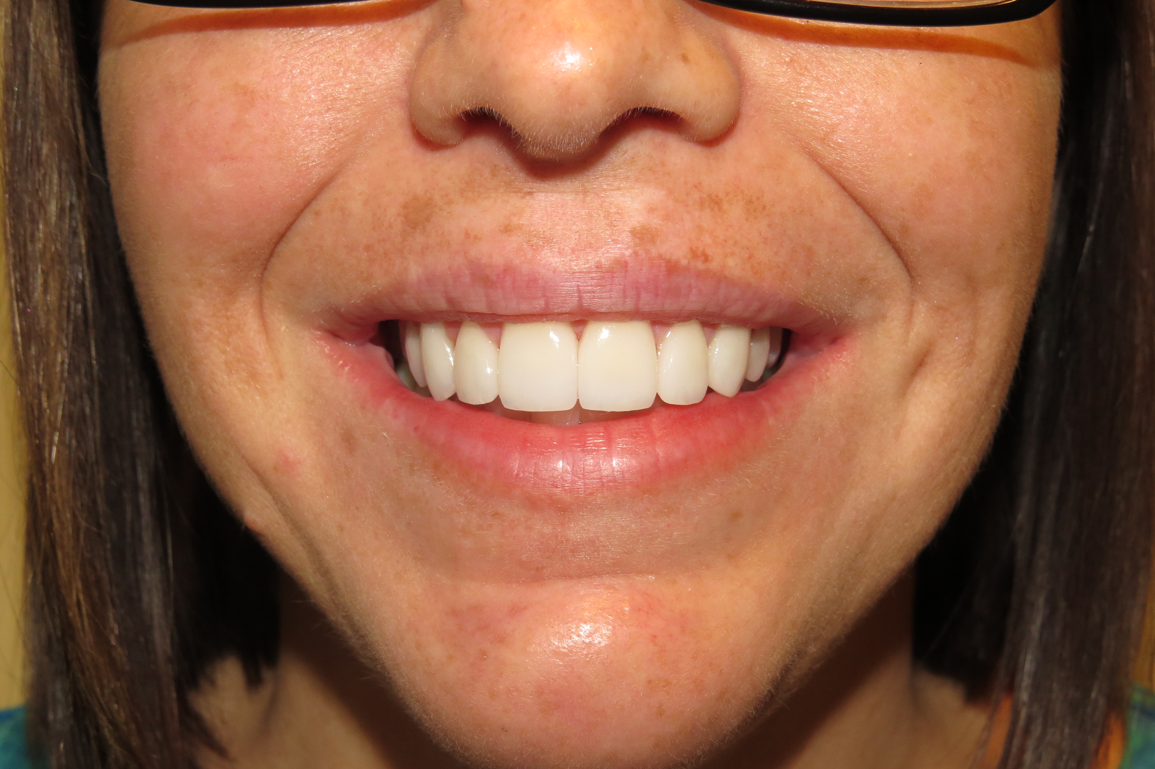 Anterior Veneer & KOR Whitening After