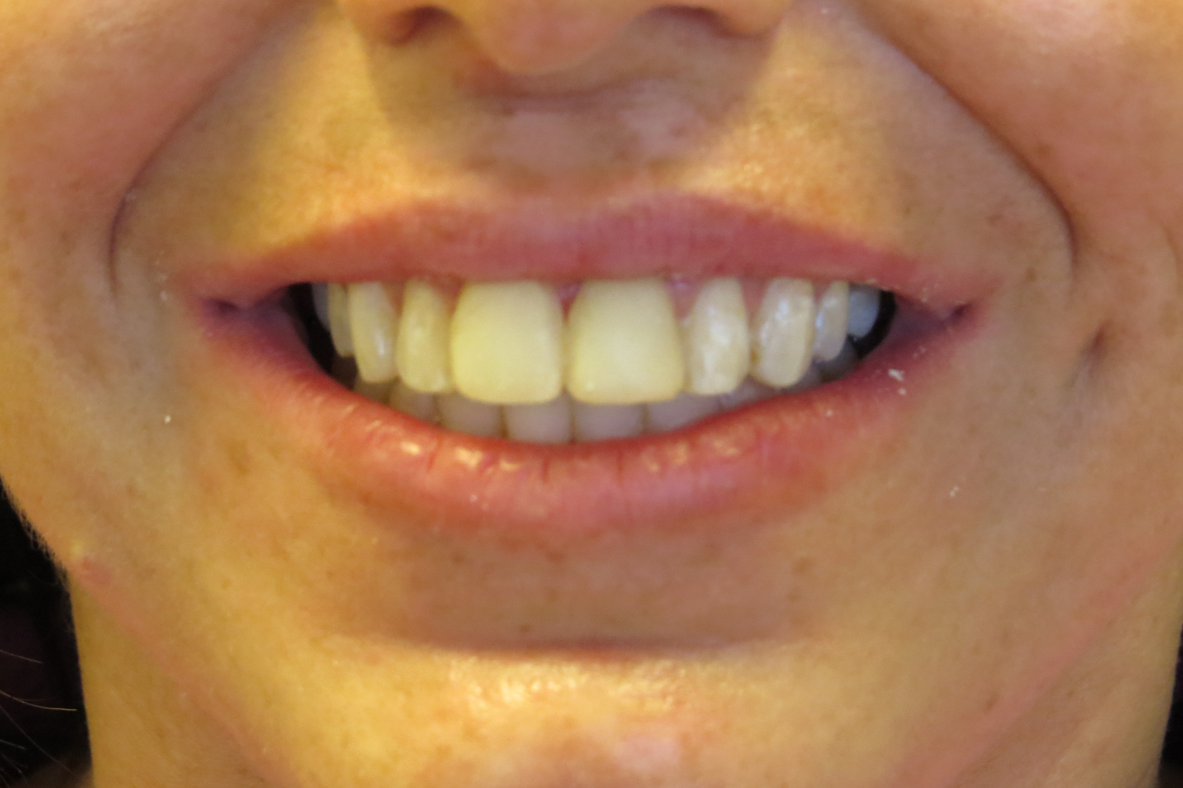 Anterior Veneer & KOR Whitening Before